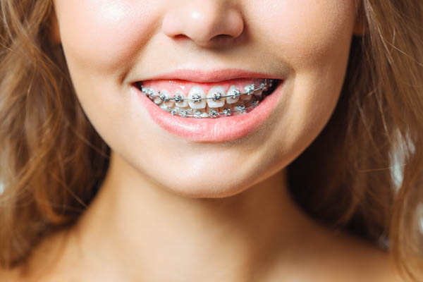 Why Clear Braces For Teens Are Recommended
