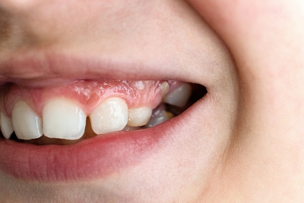 Three Common Types Of Early Orthodontic Treatment